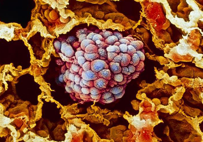 Lung cancer. Coloured scanning electron micro- graph (SEM) of a small cancerous tumour (blue) filling an alveolus of the human lung. Alveoli are the blind-ended air sacs which make up the lungs. Here, the individual cancer cells are coated with