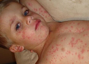 measles_in_kids