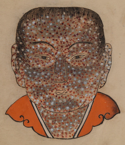 Лицо больного оспой (японский манускрипт, 1720)